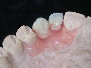 Laboratorio odontotecnico Nuovaodontotecnica Roma | Ponti rimovilili ribasabili post estrazione