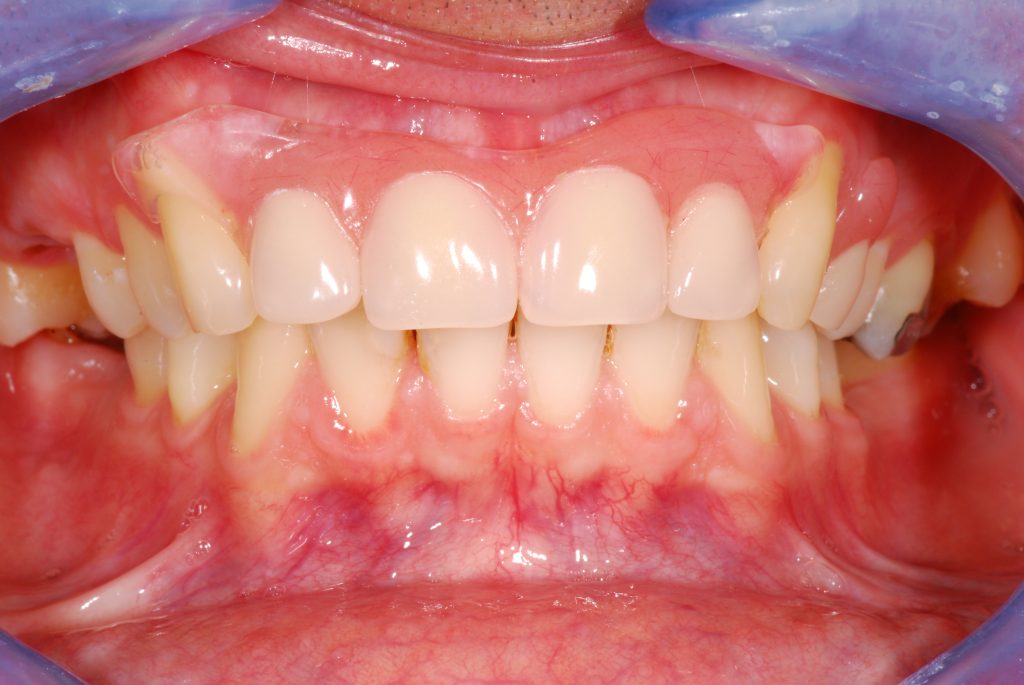 SOLUZIONI DENTALI NON INVASIVE